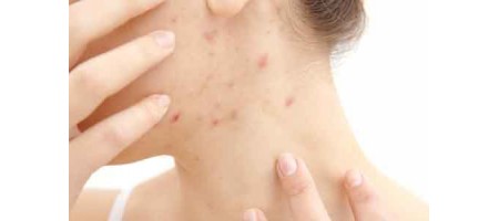 「大人のニキビ」を増やす食事と減らす食事とは?