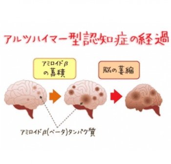 認知症の原因物質-歯周病によって蓄積する仕組みを解明