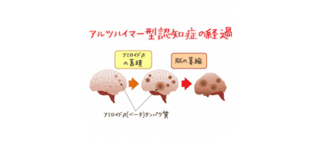 認知症の原因物質-歯周病によって蓄積する仕組みを解明