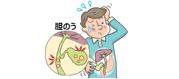 胆石をほっとくとどうなるのか!?知らないと後で怖い思いをするかも!?