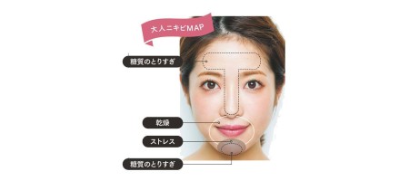 大人のニキビに効く!? アダパレンゲルで最強のすべすべ肌に!