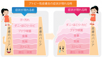 アトピーの痒みを根元から絶つ! 痒み発症する物質を抑制の化合物開発