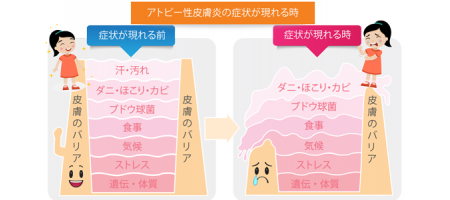 アトピーの痒みを根元から絶つ! 痒み発症する物質を抑制の化合物開発